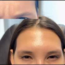 Модель на ботокс Full Face (Лицо + Шея), в Москве