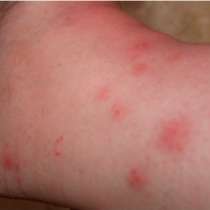 Уничтожение бельевых клещей, в Москве