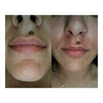 Шугаринг- Депиляция, в г.Хеб